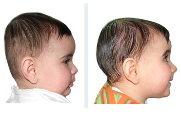Прием ортопедов деформация головы у ребенка Ортотис Премиум